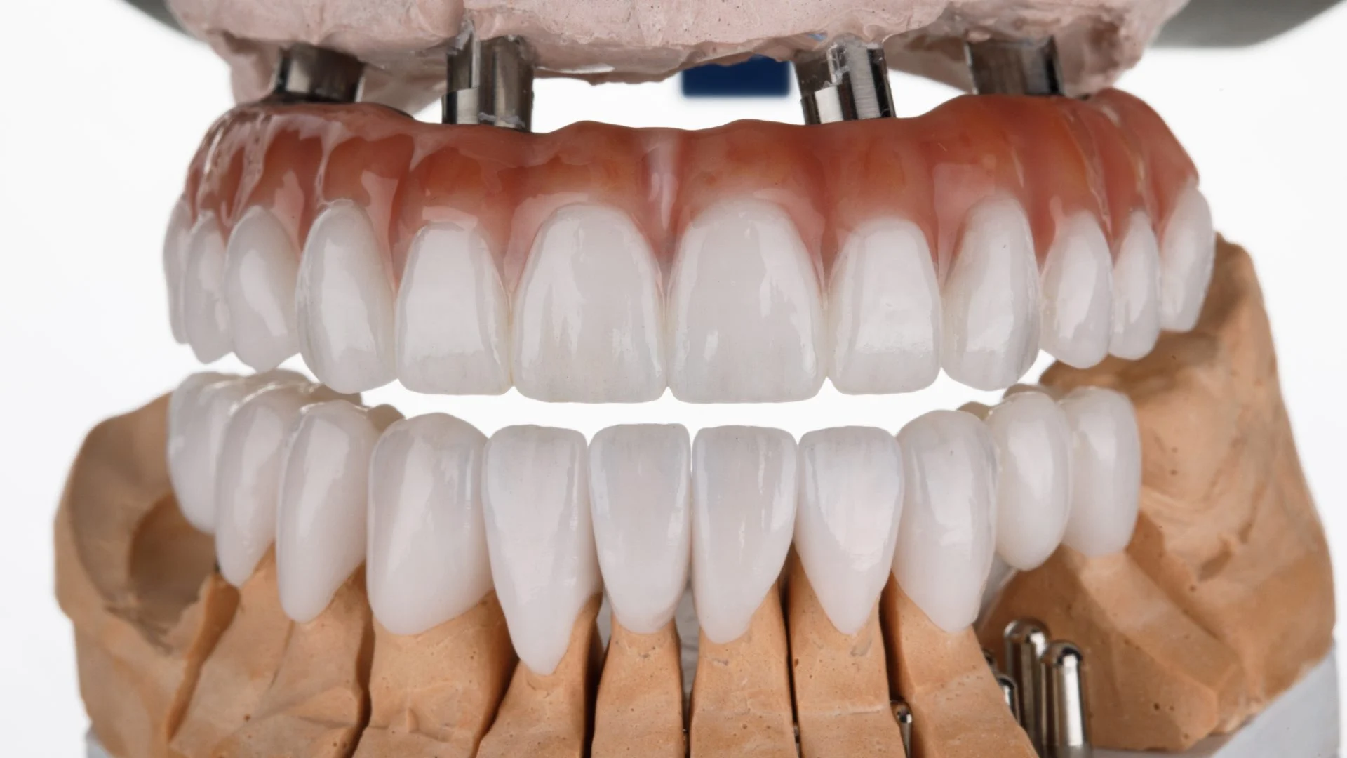 Zircon prosthesis with gum and crown for the lower jaw on a white background