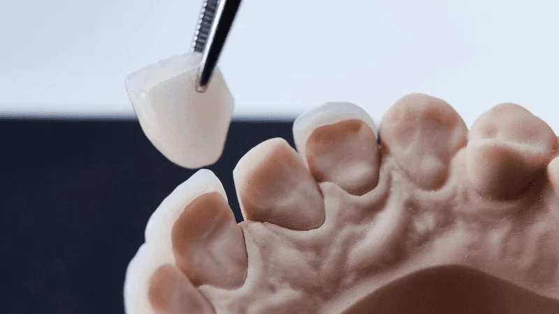 fake looking veneers