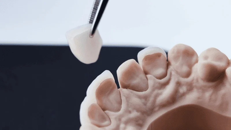 when to replace veneers