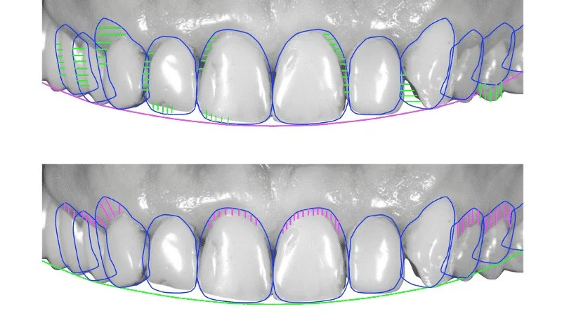 digital-smile-design-how-dentists-plan-your-perfect-smile