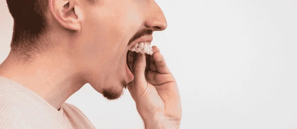 Invisalign vs SureSmile