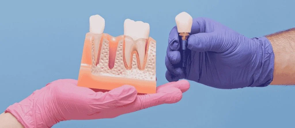 when to get a dental implant after tooth loss